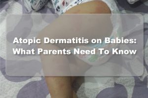 Atopic Dermatitis In Babies: What Parents Need To Know